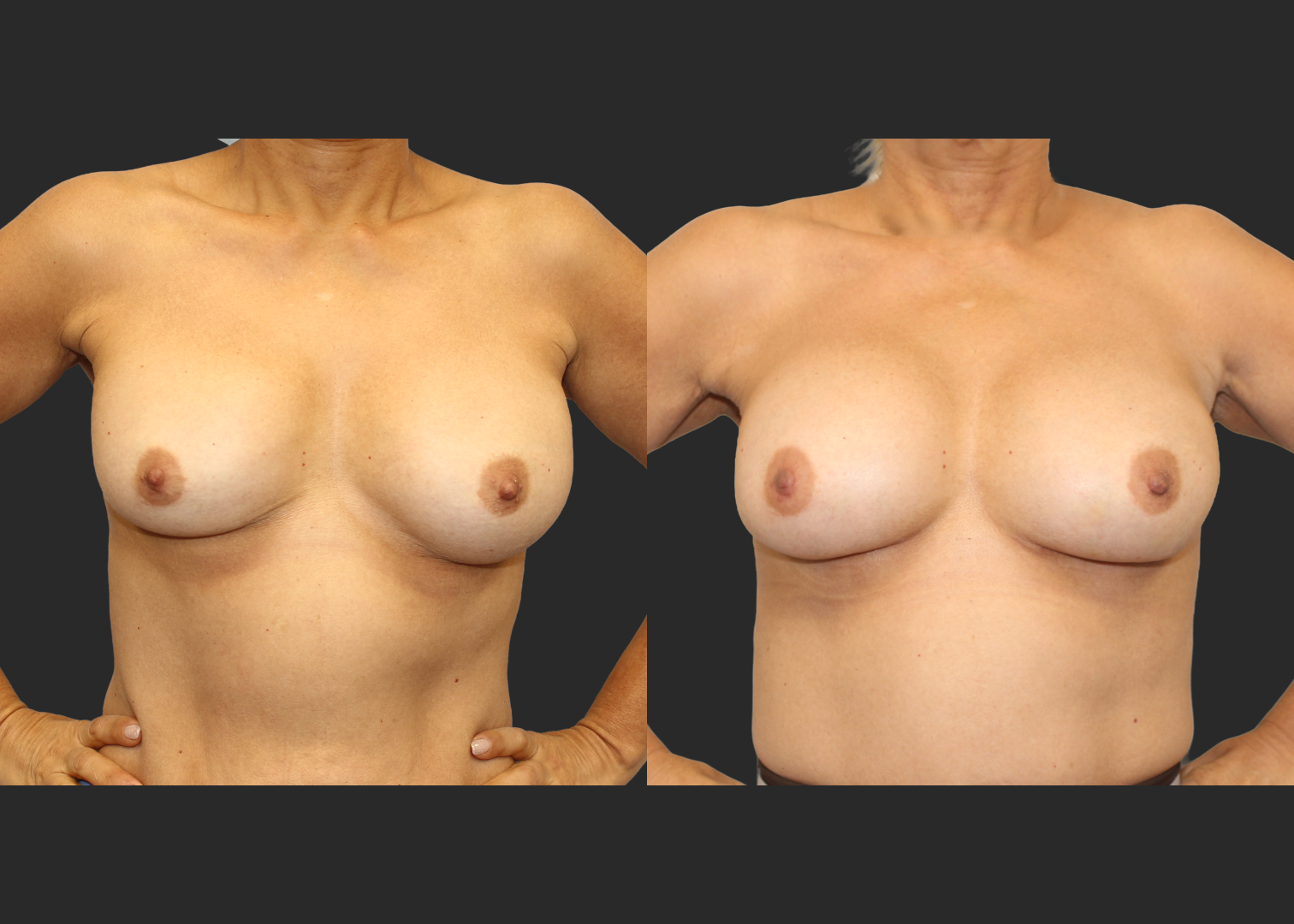 313623_Breast Implant Revision_McGhan 390cc Saline Explant_Right Partially Deflated_Allergan Inspira SRM 295cc Silicone_Bilateral Lateral Capsulorrhaphy Pocket Correction_Before and After 2 months_Front