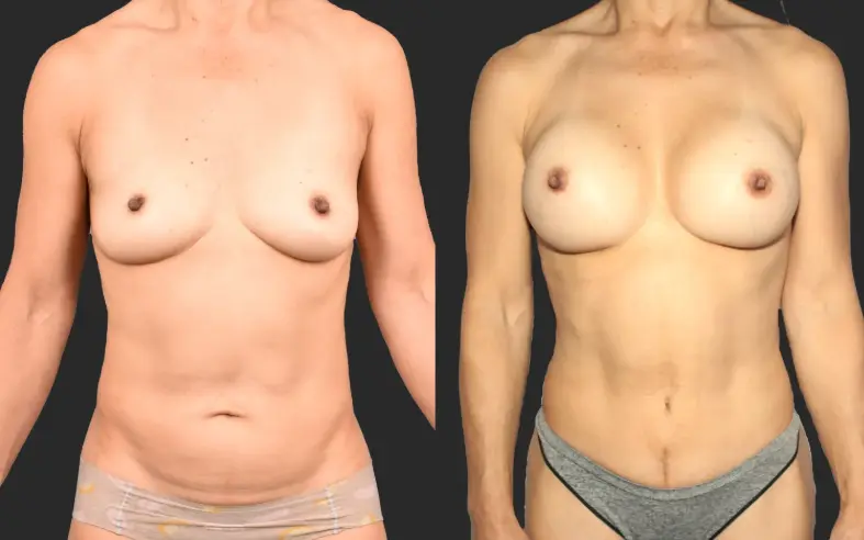 spotlight-ba-motiva-breast-implants