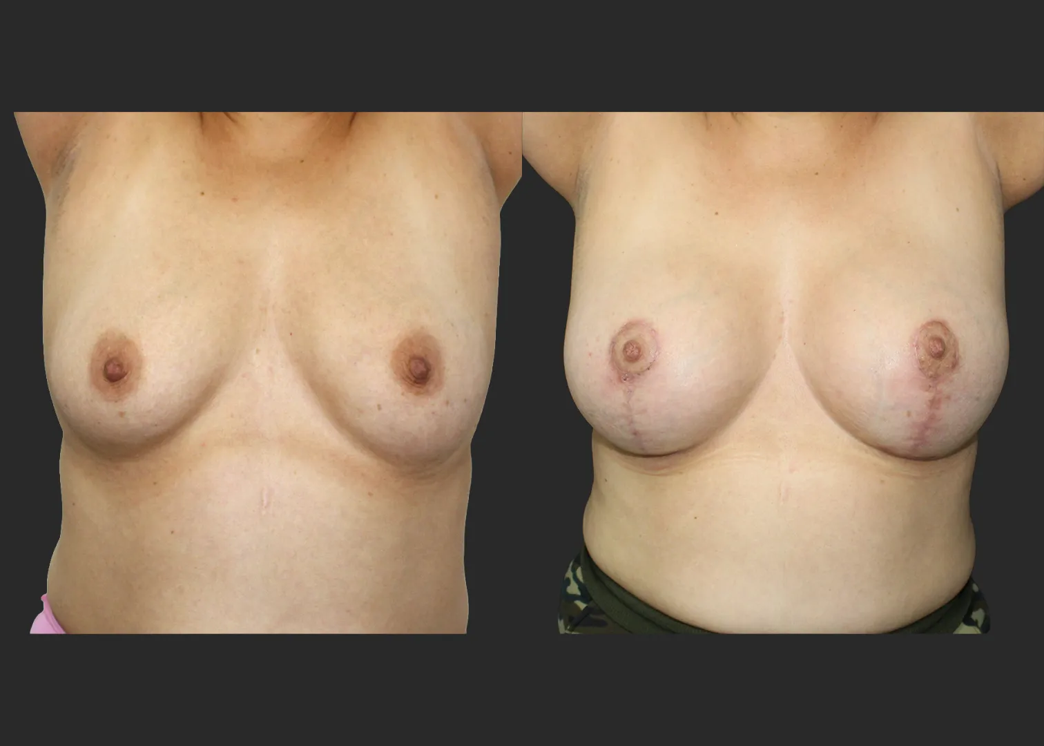 012126_Augmentation Mastopexy_Before and After 2 months_Front