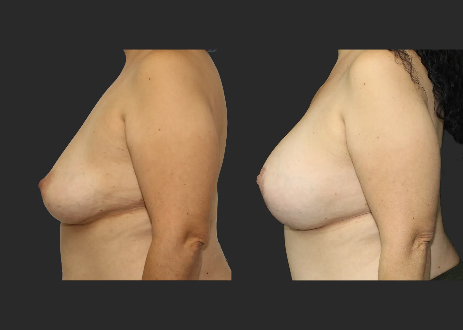 012126_Augmentation Mastopexy_Before and After 2 months_Left