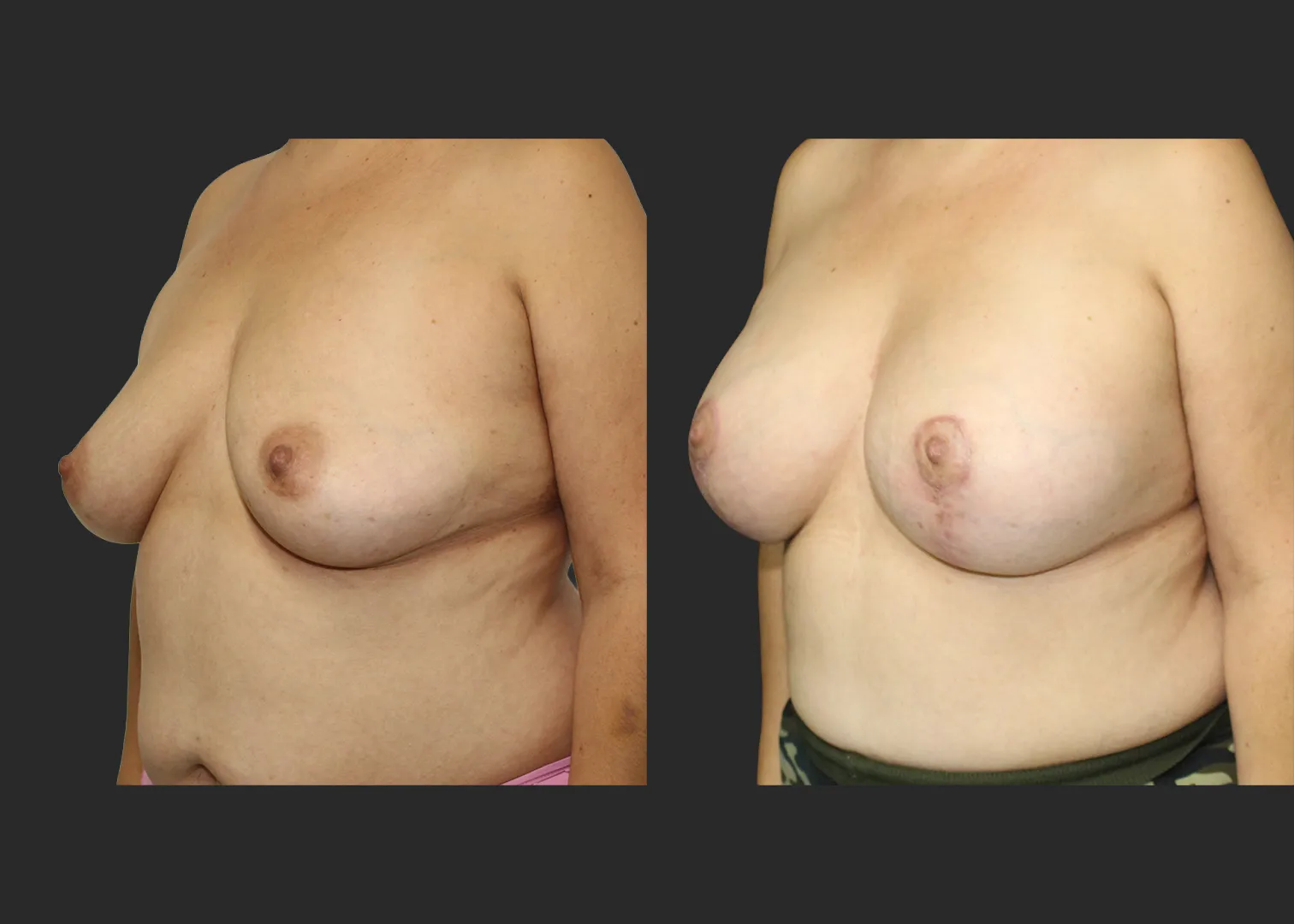 012126_Augmentation Mastopexy_Before and After 2 months_LeftOblique