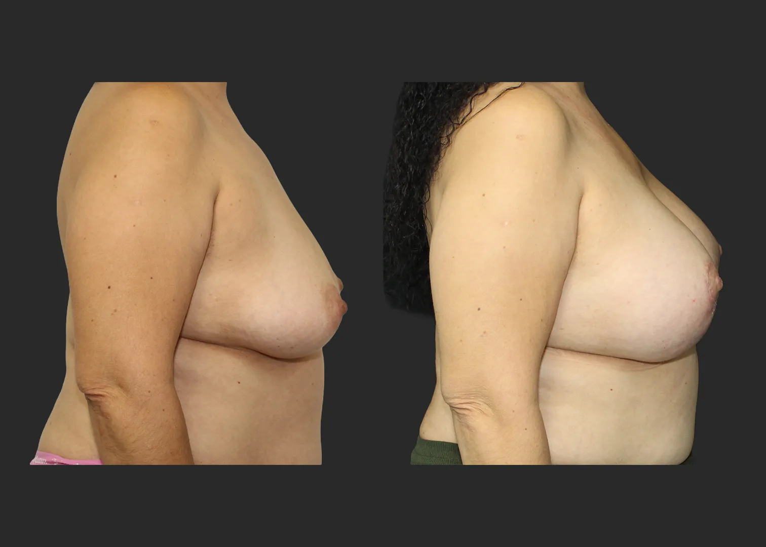 012126_Augmentation Mastopexy_Before and After 2 months_Right