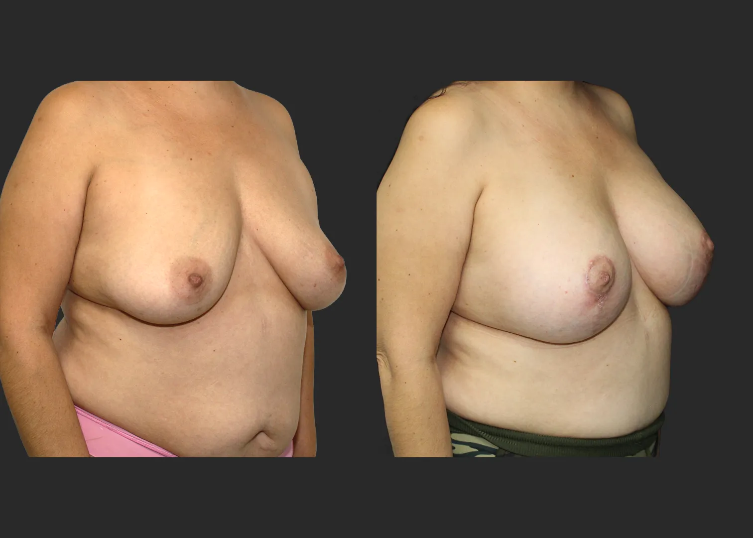 012126_Augmentation Mastopexy_Before and After 2 months_RightOblique