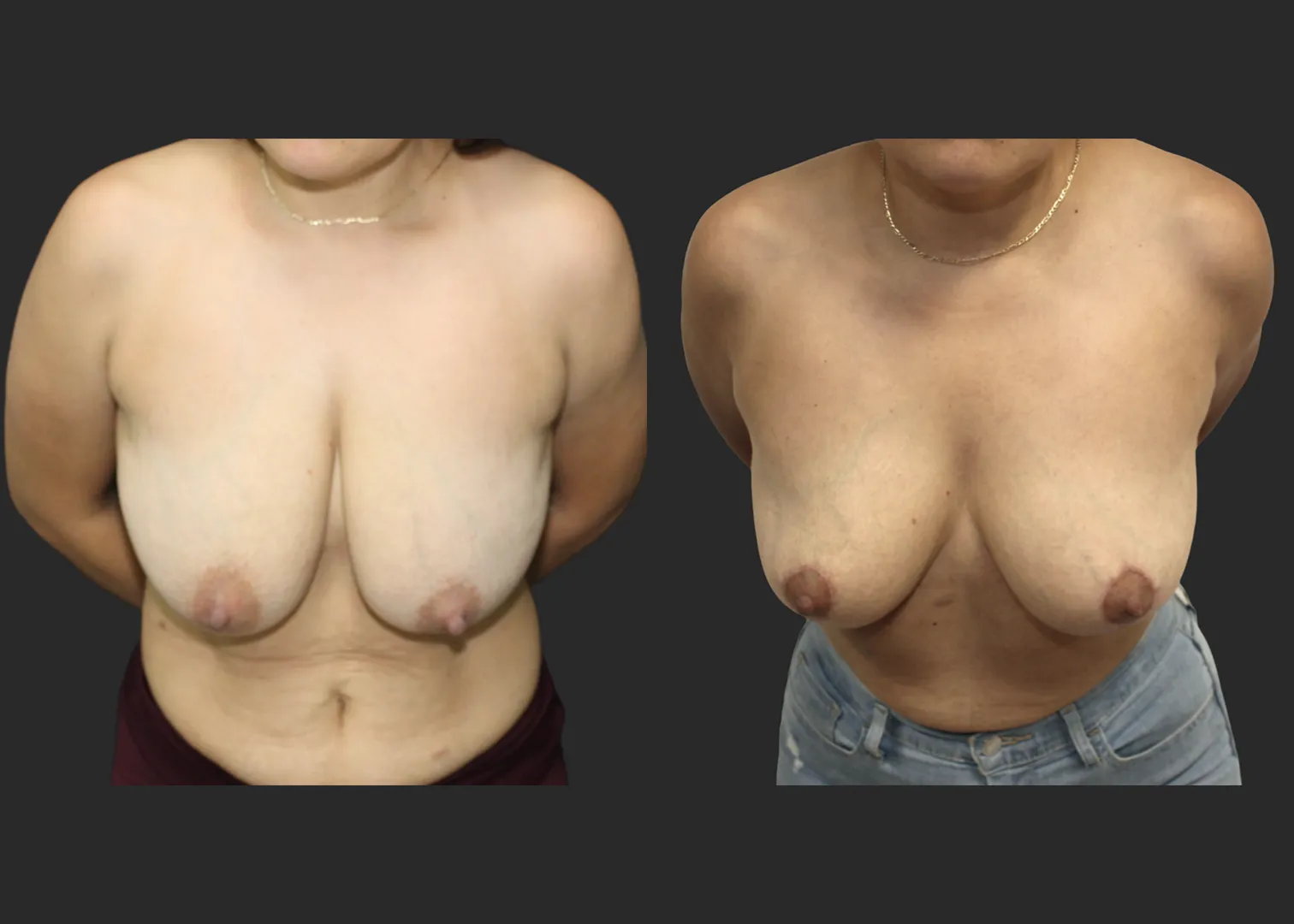 012826_Breast Lift_Inverted T Mastopexy_Vertical Mastopexy_Autoaugmentation_Before and After 6 months_BentForward