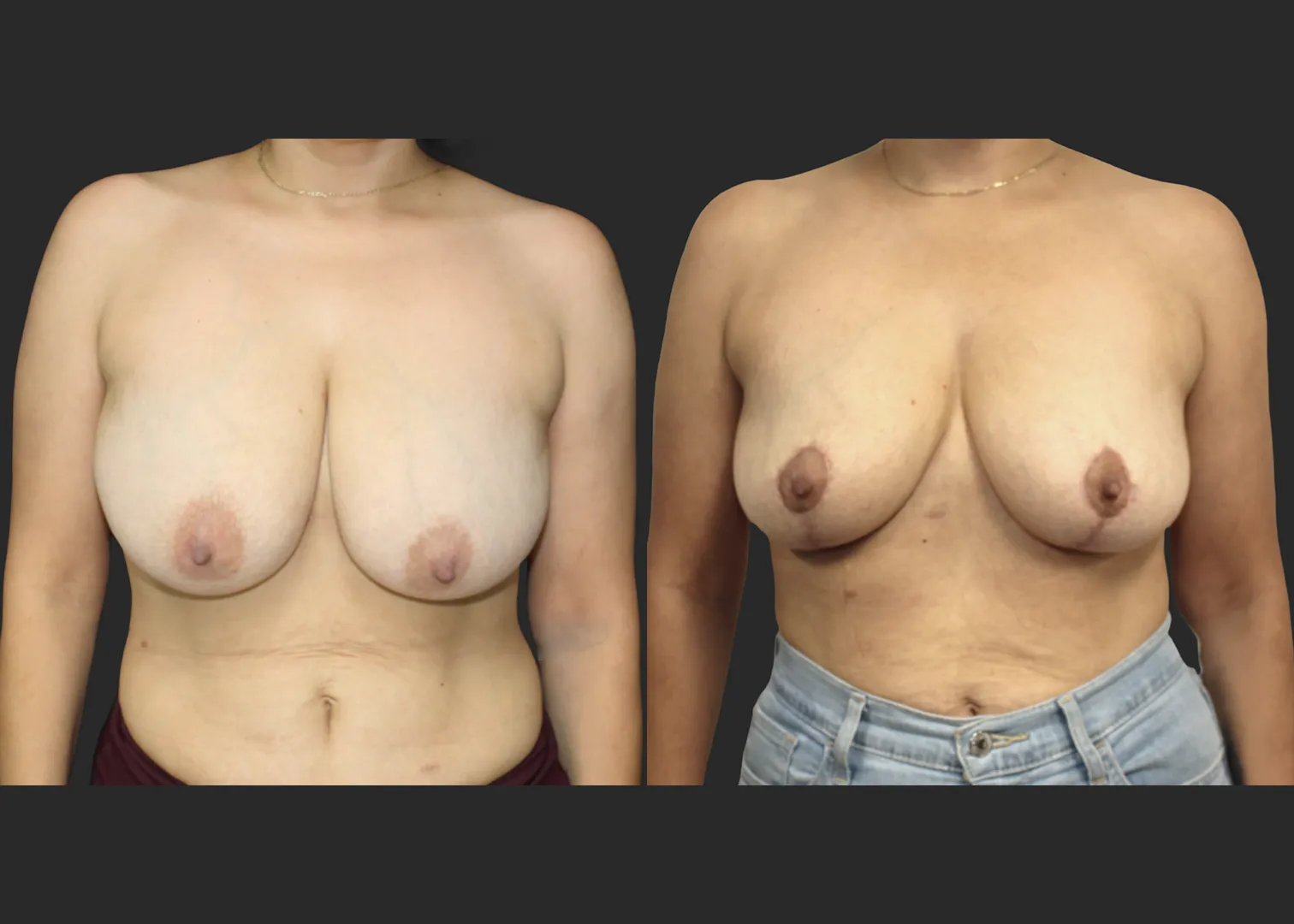 012826_Breast Lift_Inverted T Mastopexy_Vertical Mastopexy_Autoaugmentation_Before and After 6 months_Front