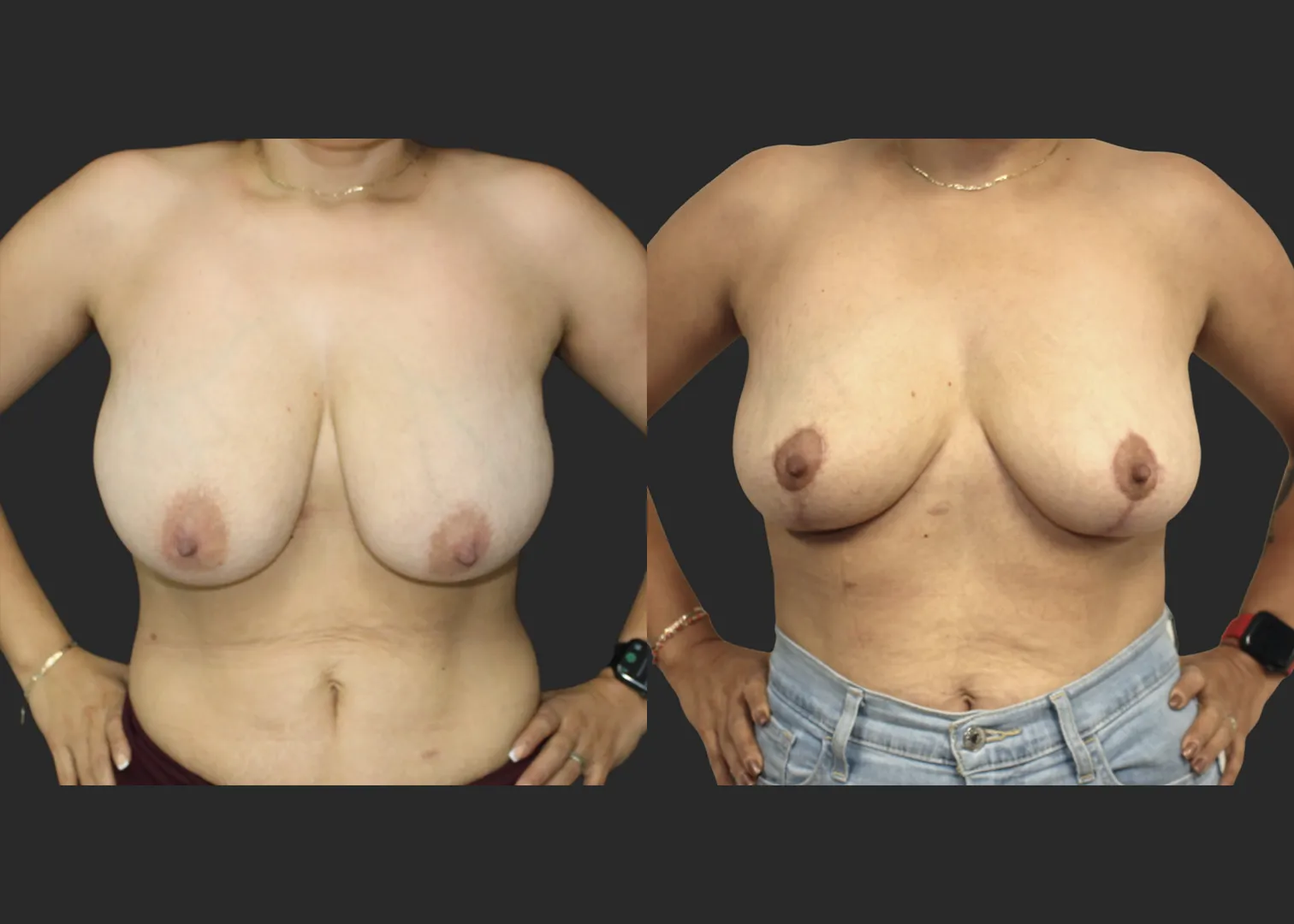 012826_Breast Lift_Inverted T Mastopexy_Vertical Mastopexy_Autoaugmentation_Before and After 6 months_FrontHandsonHips