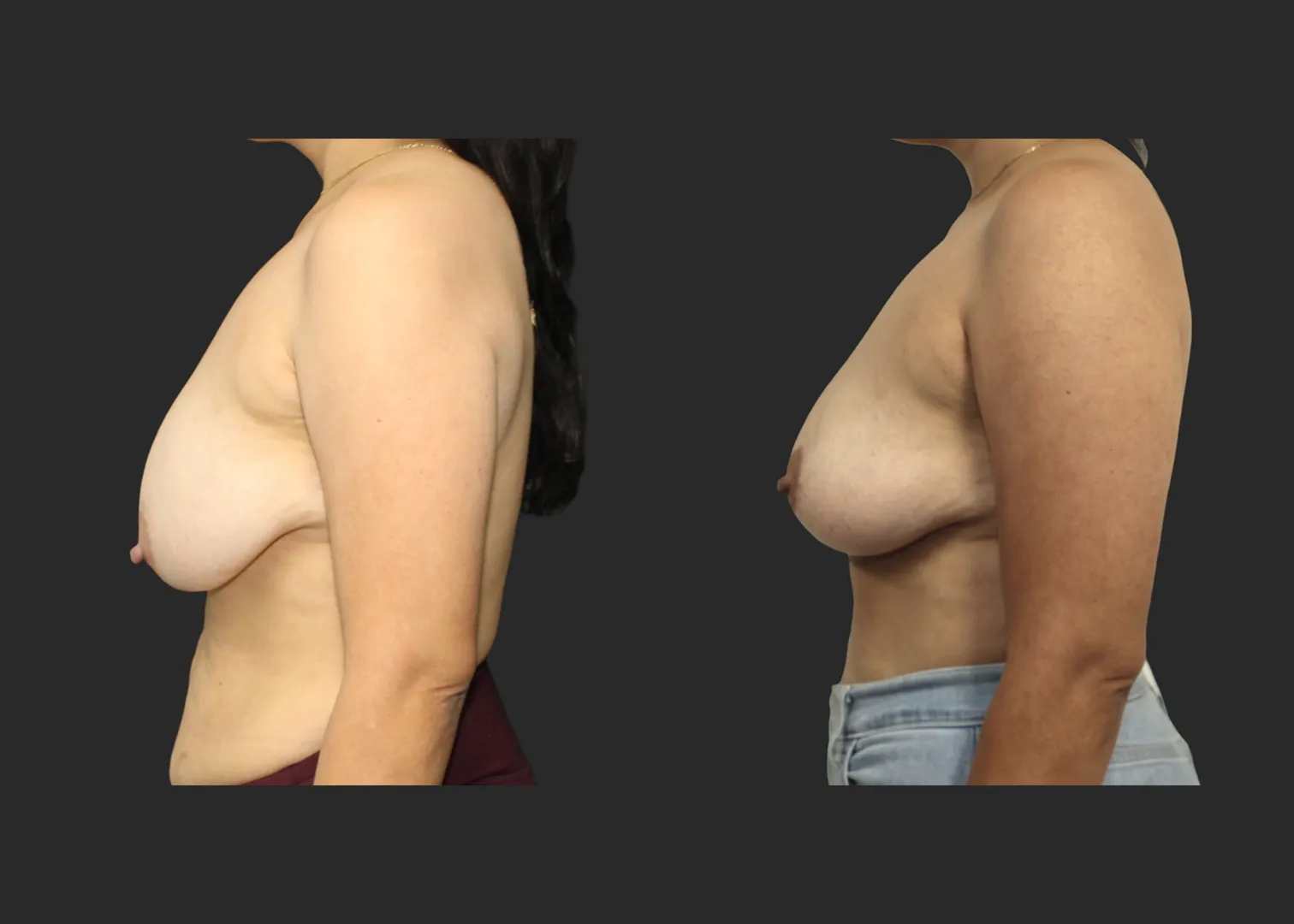 012826_Breast Lift_Inverted T Mastopexy_Vertical Mastopexy_Autoaugmentation_Before and After 6 months_Left