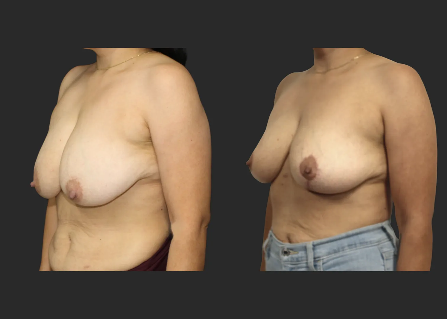 012826_Breast Lift_Inverted T Mastopexy_Vertical Mastopexy_Autoaugmentation_Before and After 6 months_LeftOblique