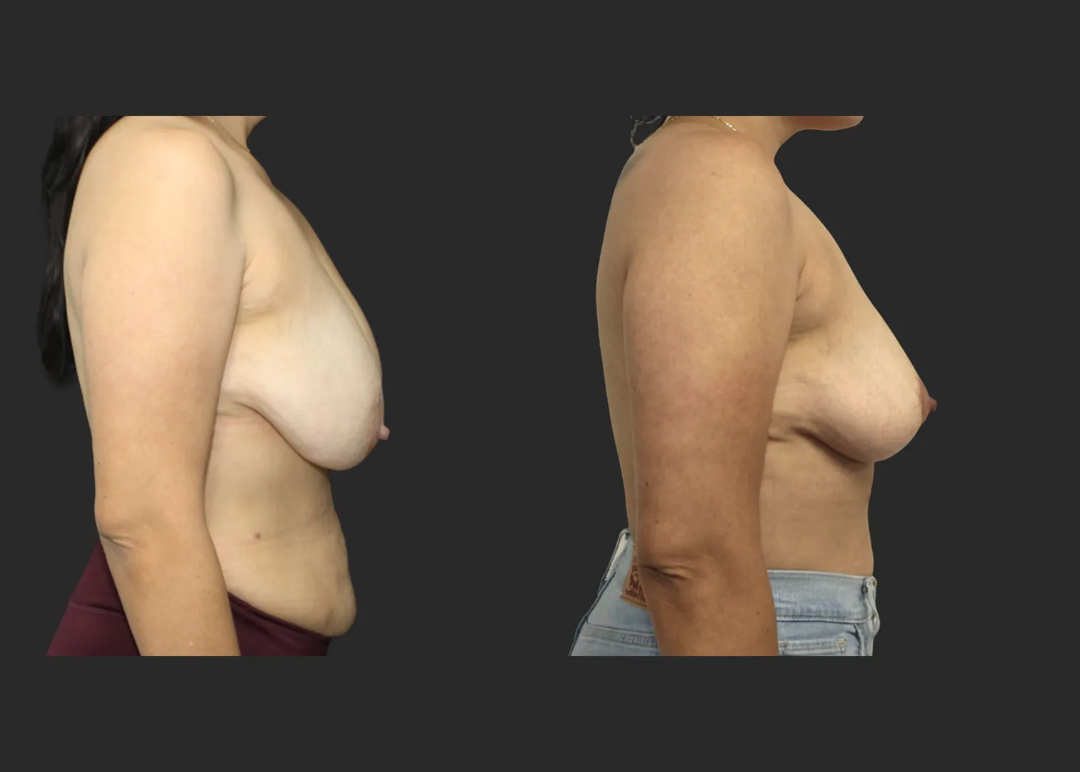 012826_Breast Lift_Inverted T Mastopexy_Vertical Mastopexy_Autoaugmentation_Before and After 6 months_Right