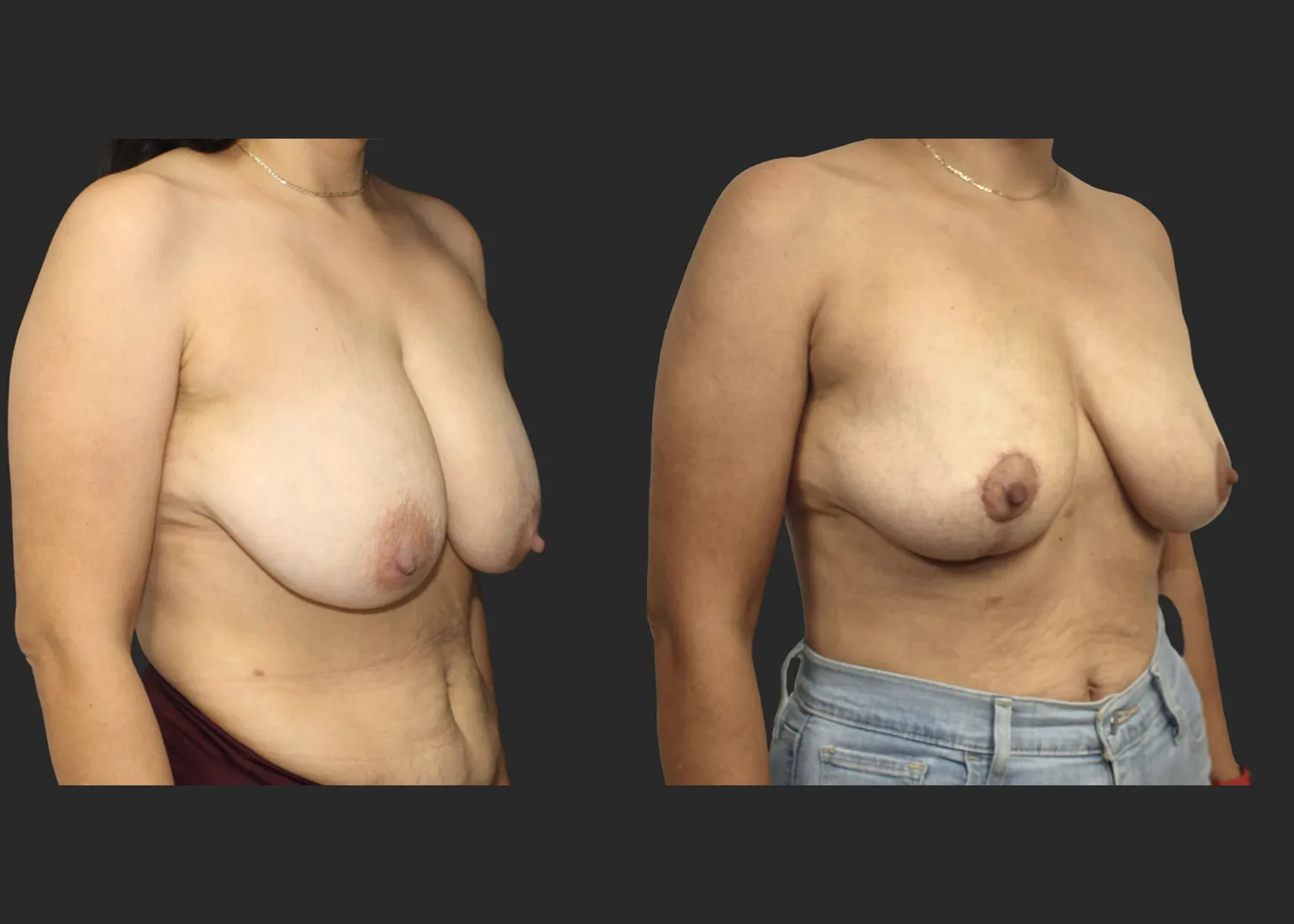 012826_Breast Lift_Inverted T Mastopexy_Vertical Mastopexy_Autoaugmentation_Before and After 6 months_RightOblique