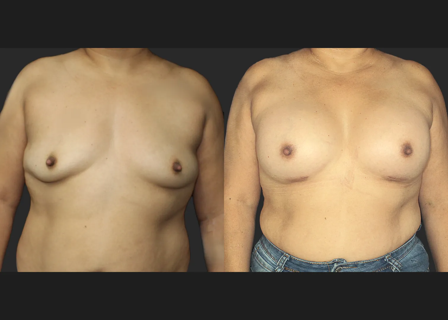 021120262 Breast Augmentation Subfascial SRX 615 cc 2 months Before After Front