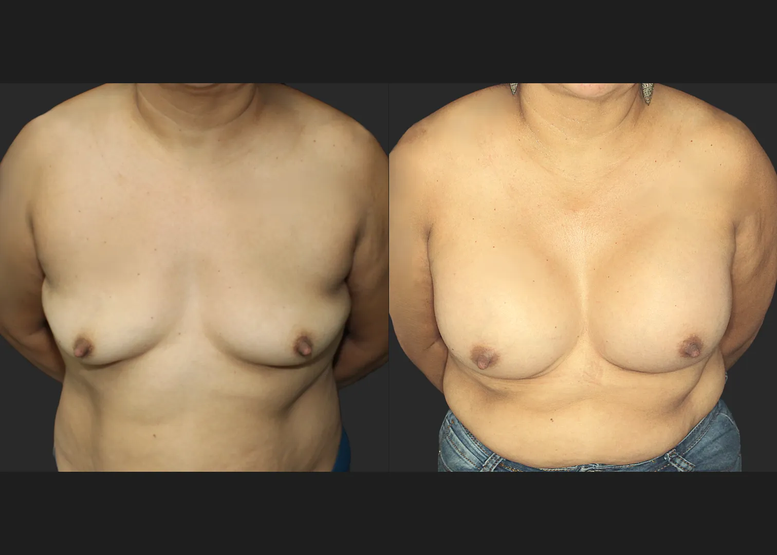 021120262 Breast Augmentation Subfascial SRX 615 cc 2 months before after cleavage