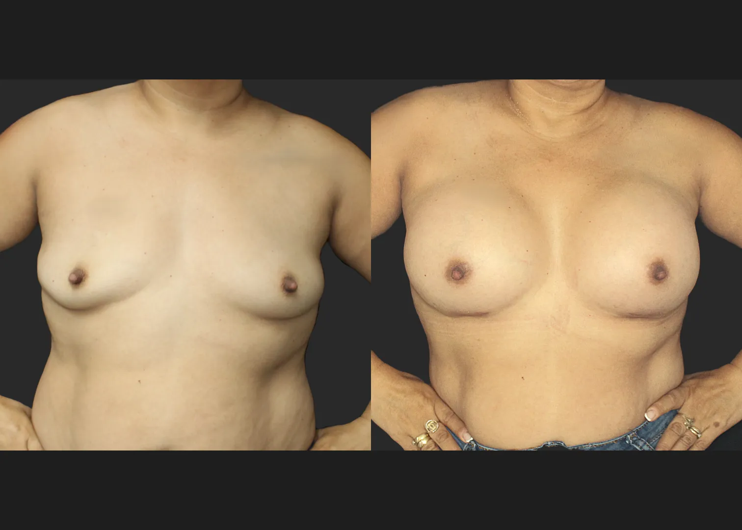021120262 Breast Augmentation Subfascial SRX 615 cc 2 months before after flexed