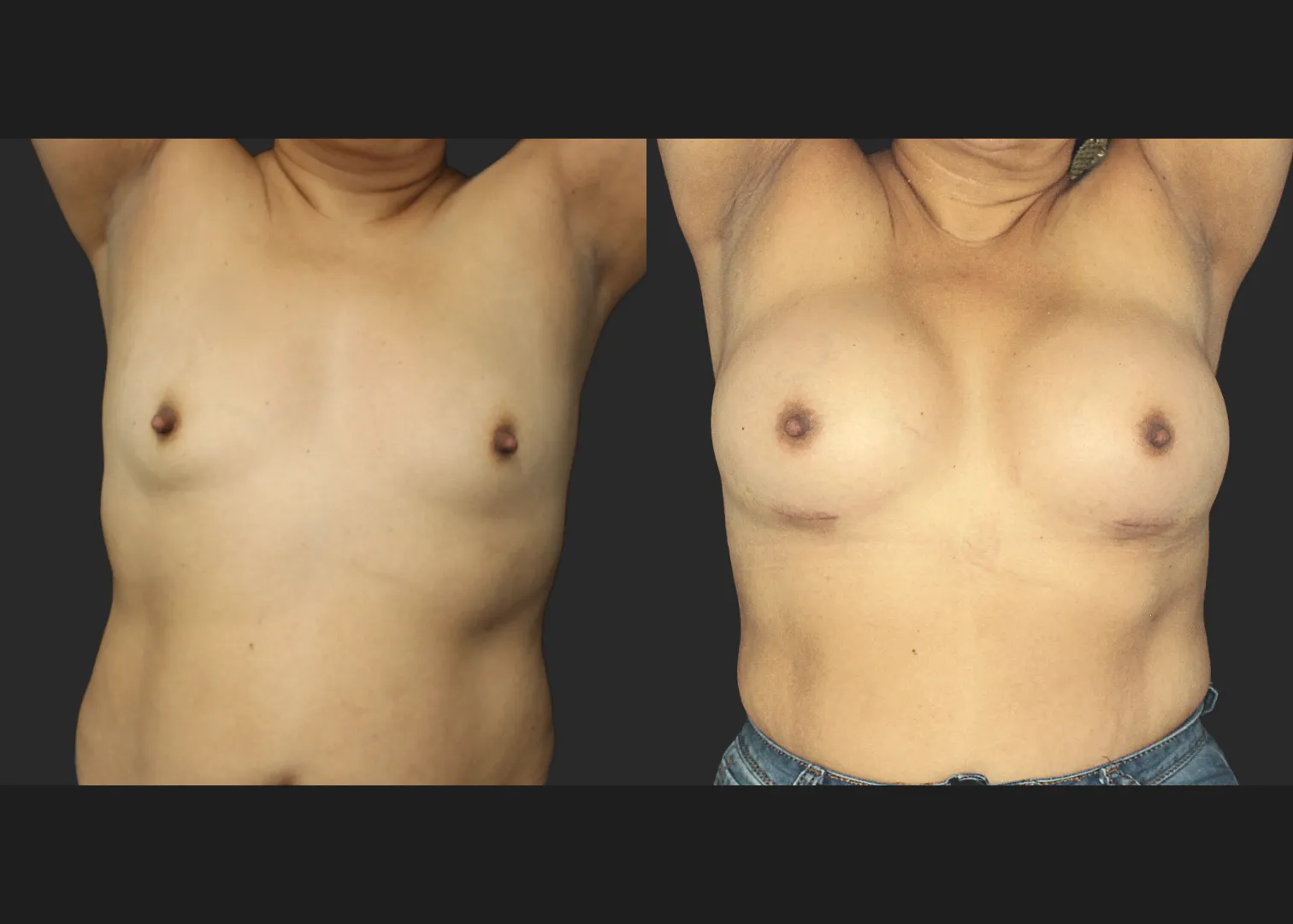 021120262 Breast Augmentation Subfascial SRX 615 cc 2 months before after front up