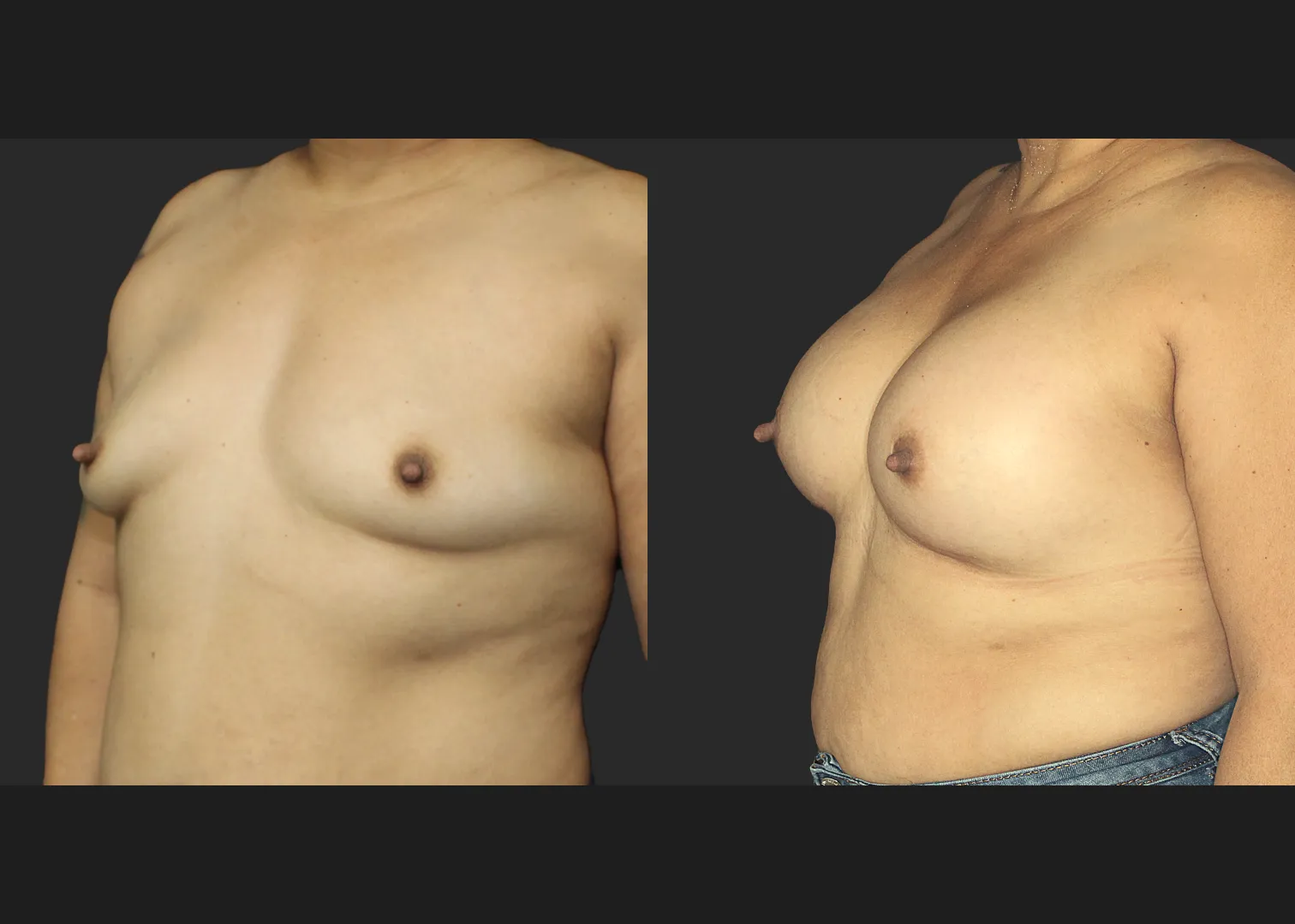 021120262 Breast Augmentation Subfascial SRX 615 cc 2 months before after left oblique