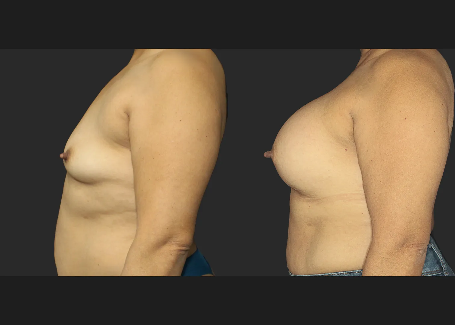 021120262 Breast Augmentation Subfascial SRX 615 cc 2 months before after left