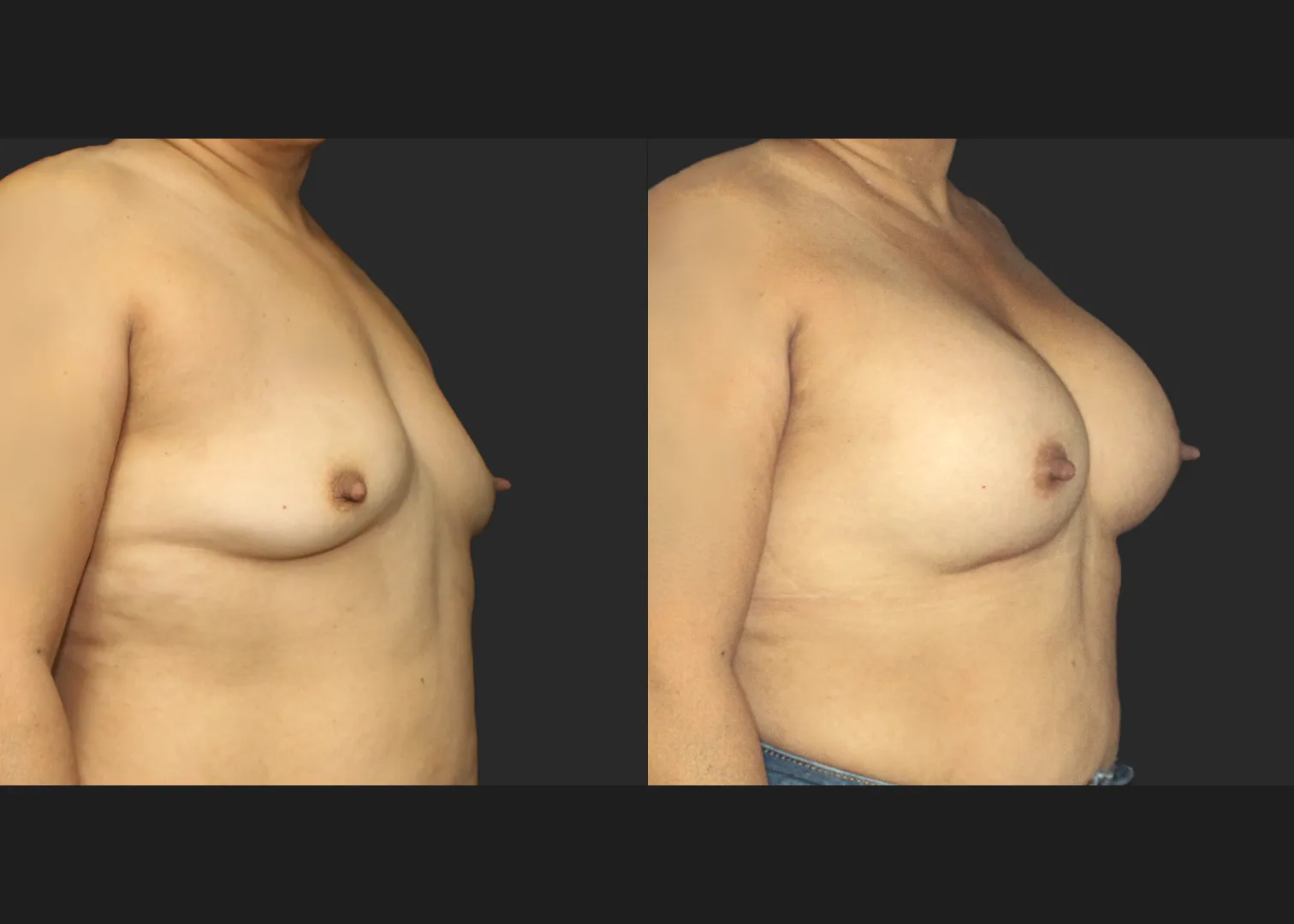 021120262 Breast Augmentation Subfascial SRX 615 cc 2 months before after right oblique