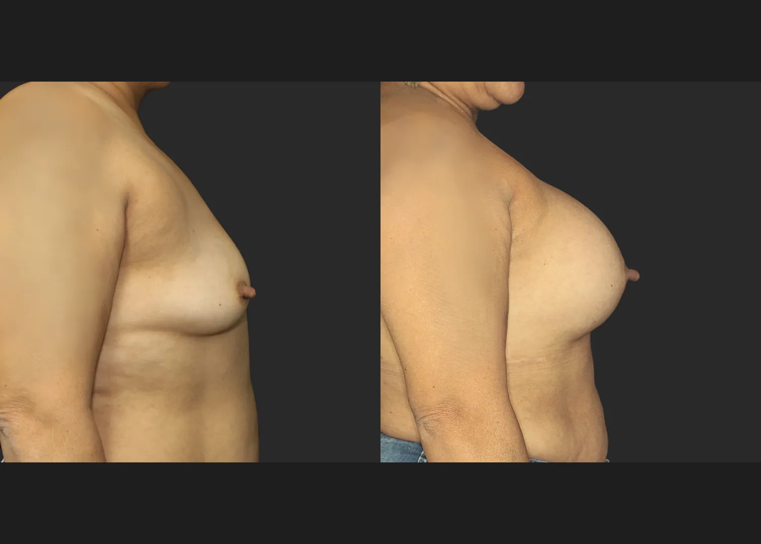 021120262 Breast Augmentation Subfascial SRX 615 cc 2 months before after right