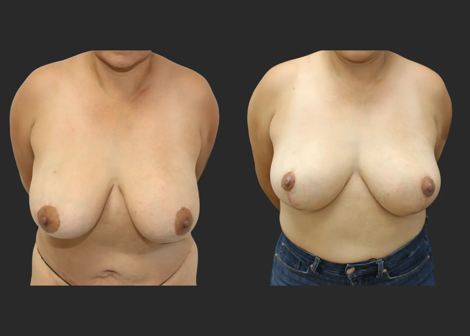 050626_1_Breast Implant Revision_Silicone_SRM 375cc Bilateral_Bilateral Capsulectomy_Secondary Inverted T Mastopexy_Superomedial Pedicle_Before and After 1.5 months_FrontBent