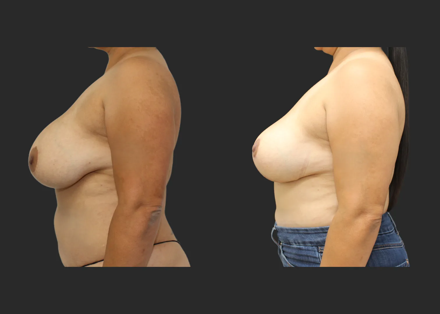 050626_1_Breast Implant Revision_Silicone_SRM 375cc Bilateral_Bilateral Capsulectomy_Secondary Inverted T Mastopexy_Superomedial Pedicle_Before and After 1.5 months_Left