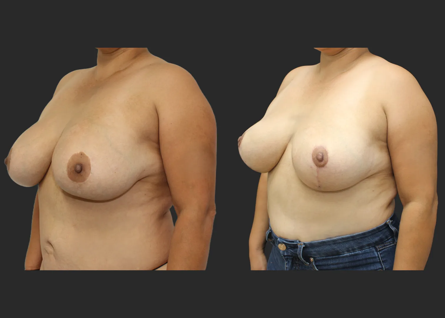 050626_1_Breast Implant Revision_Silicone_SRM 375cc Bilateral_Bilateral Capsulectomy_Secondary Inverted T Mastopexy_Superomedial Pedicle_Before and After 1.5 months_LeftOblique