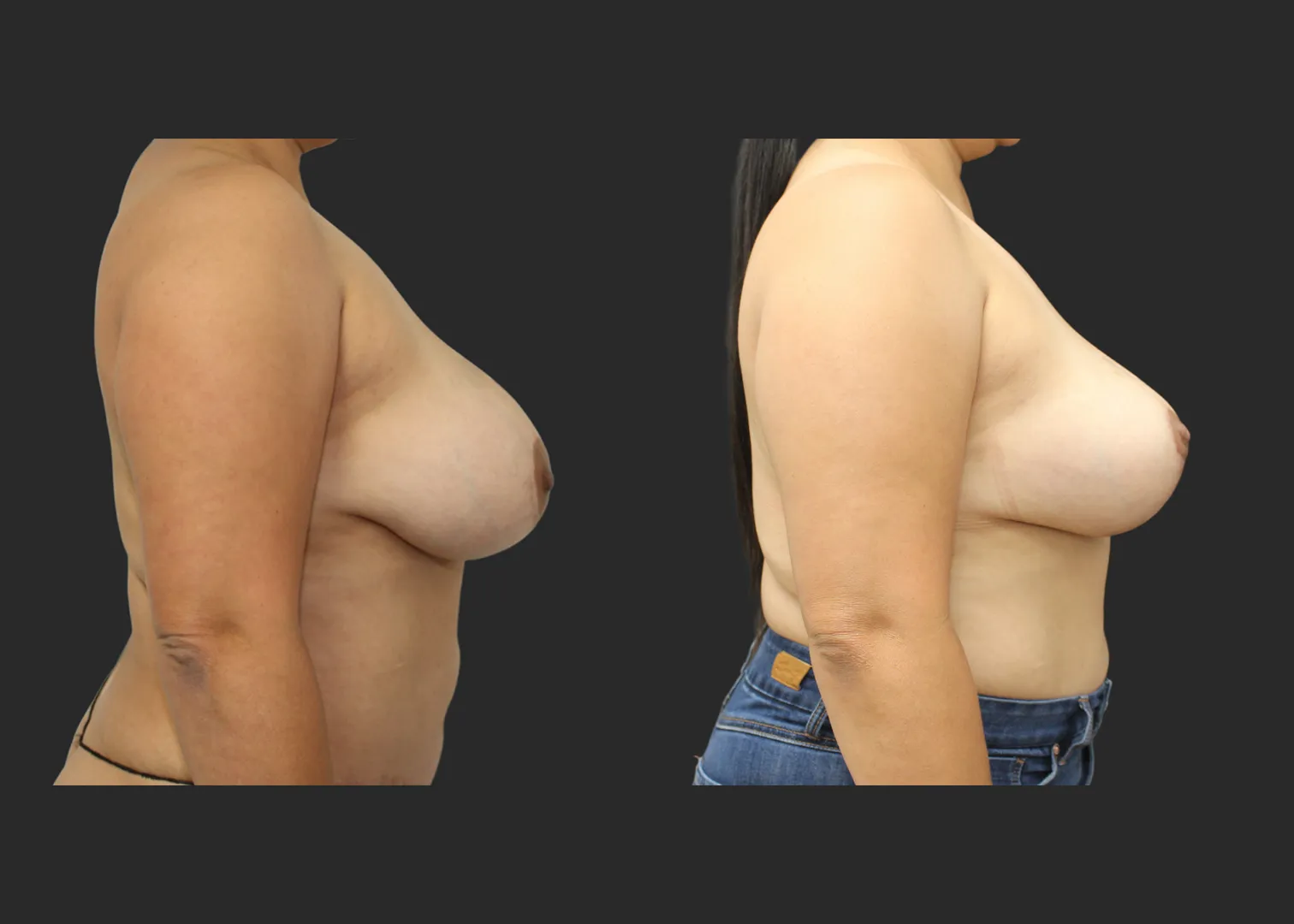 050626_1_Breast Implant Revision_Silicone_SRM 375cc Bilateral_Bilateral Capsulectomy_Secondary Inverted T Mastopexy_Superomedial Pedicle_Before and After 1.5 months_Right