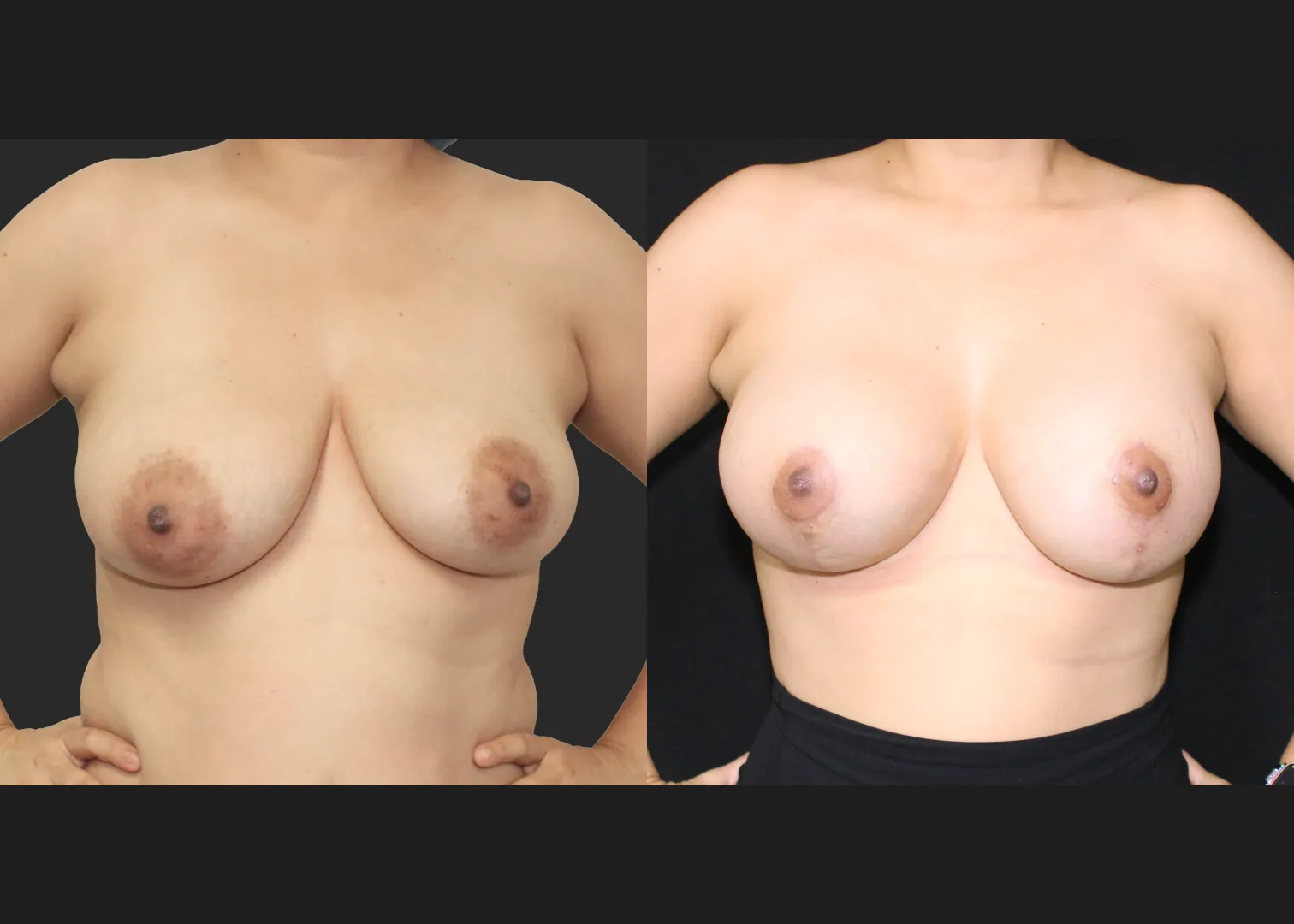 091725_Breast Augmentation Mastopexy lift subpectoral allergan natrelle inspira smooth round moderate profile SRM 345 cc gummy implants before after 2.5 months front flexed