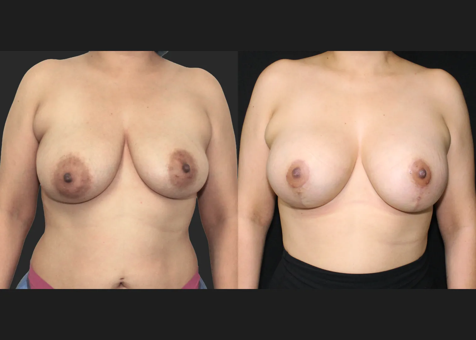 091725_Breast Augmentation Mastopexy lift subpectoral allergan natrelle inspira smooth round moderate profile SRM 345 cc gummy implants before after 2.5 months front