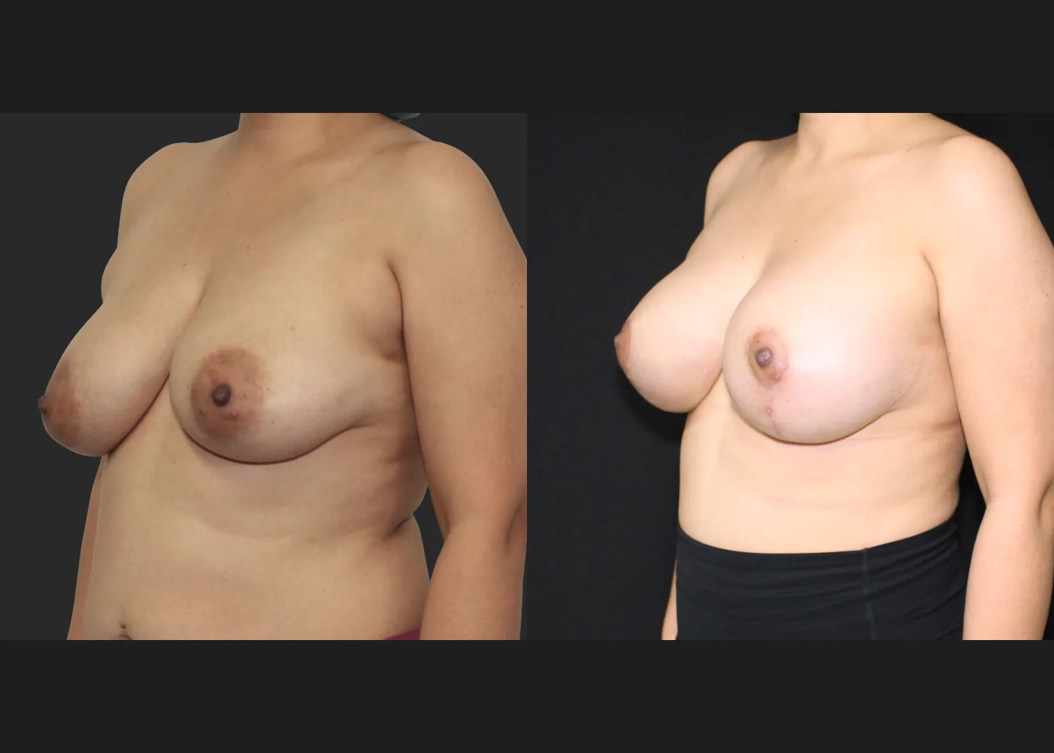 091725_Breast Augmentation Mastopexy lift subpectoral allergan natrelle inspira smooth round moderate profile SRM 345 cc gummy implants before after 2.5 months left oblique