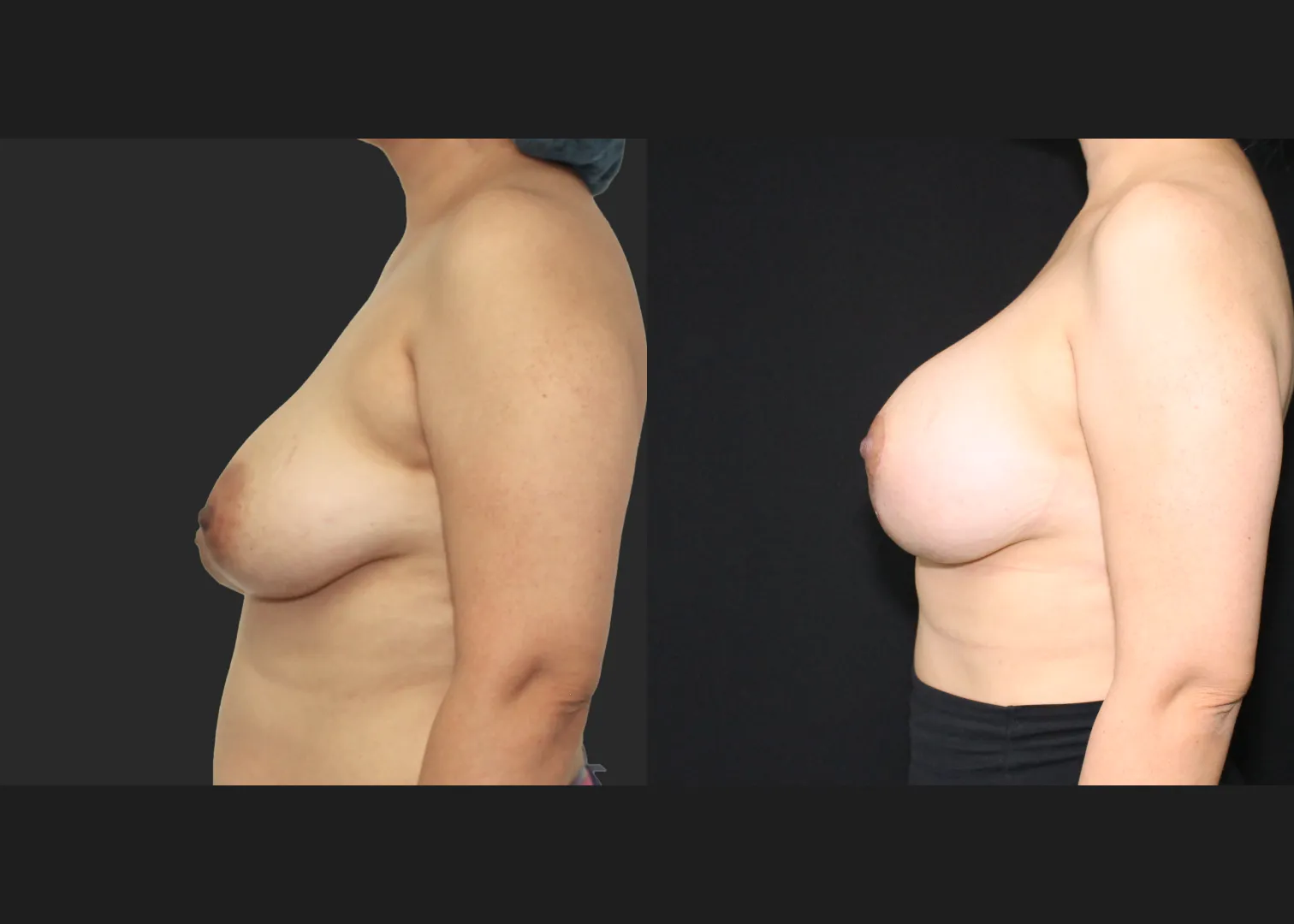 091725_Breast Augmentation Mastopexy lift subpectoral allergan natrelle inspira smooth round moderate profile SRM 345 cc gummy implants before after 2.5 months left