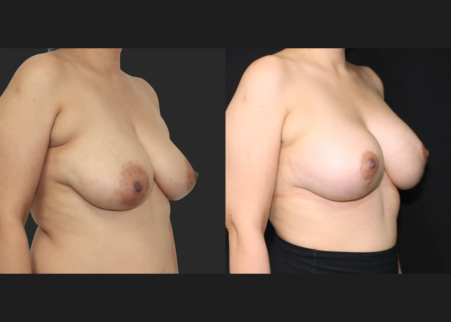 091725_Breast Augmentation Mastopexy lift subpectoral allergan natrelle inspira smooth round moderate profile SRM 345 cc gummy implants before after 2.5 months right oblique