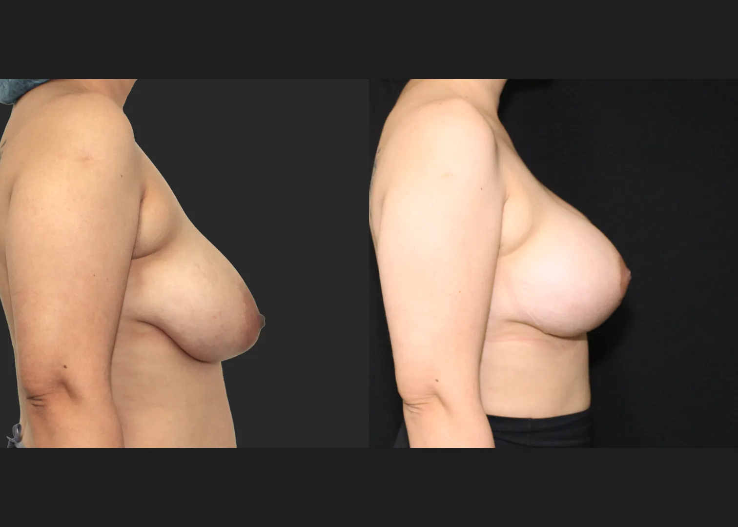 091725_Breast Augmentation Mastopexy lift subpectoral allergan natrelle inspira smooth round moderate profile SRM 345 cc gummy implants before after 2.5 months right