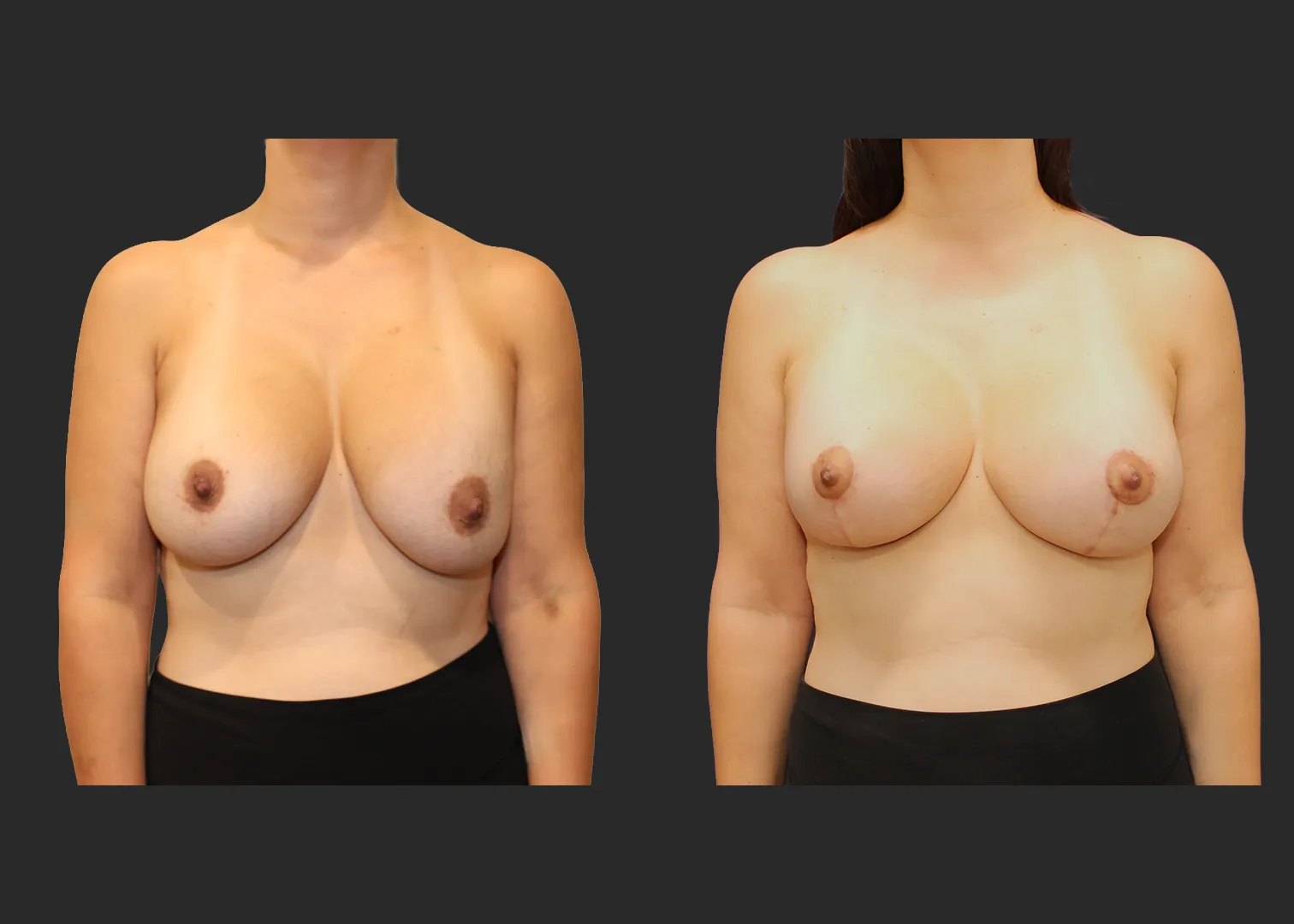 322890_Breast Implant Revision_Front