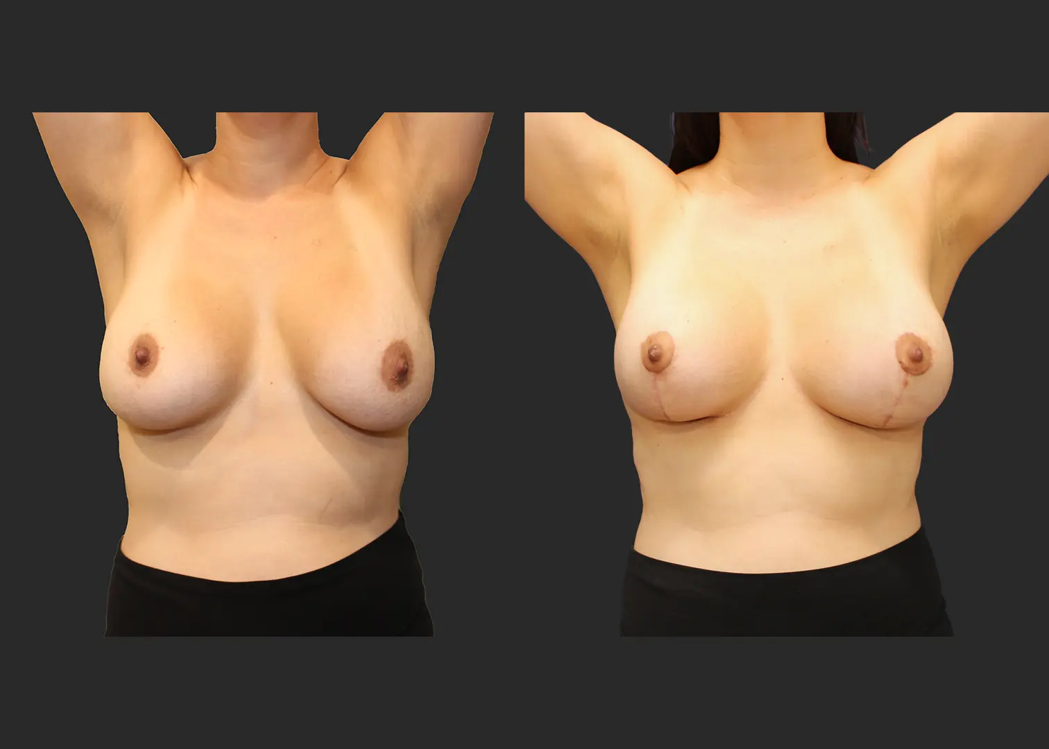 322890_Breast Implant Revision_Front_Arms Raised