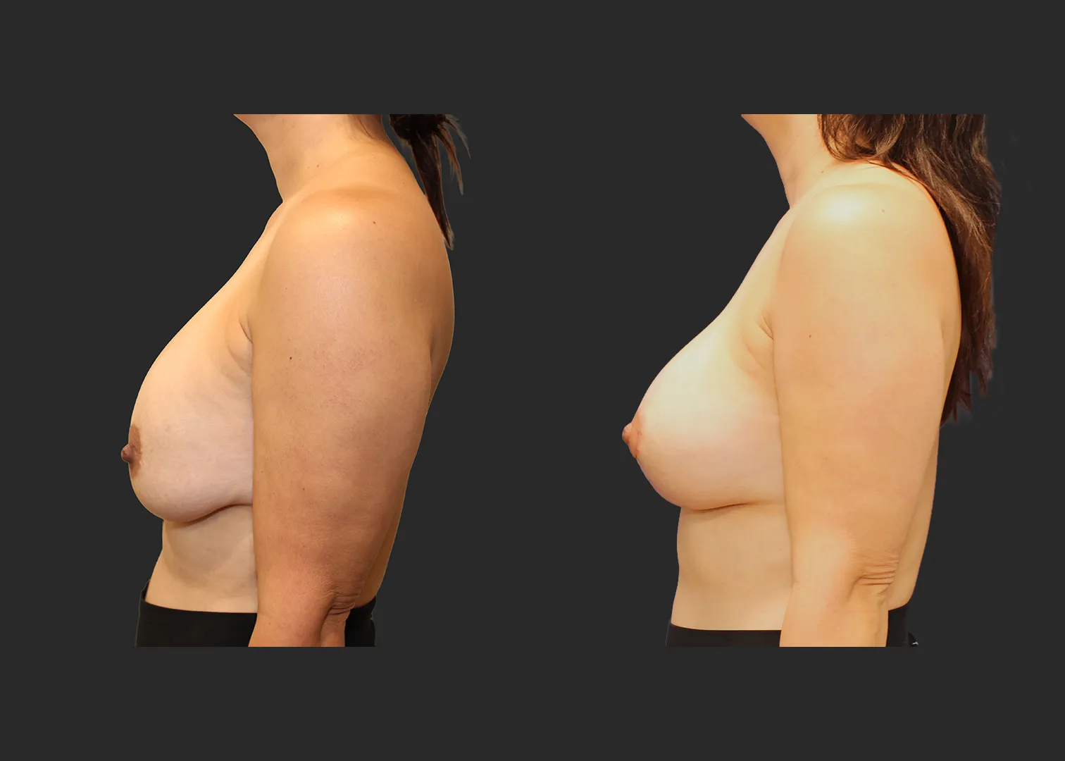 322890_Breast Implant Revision_Left