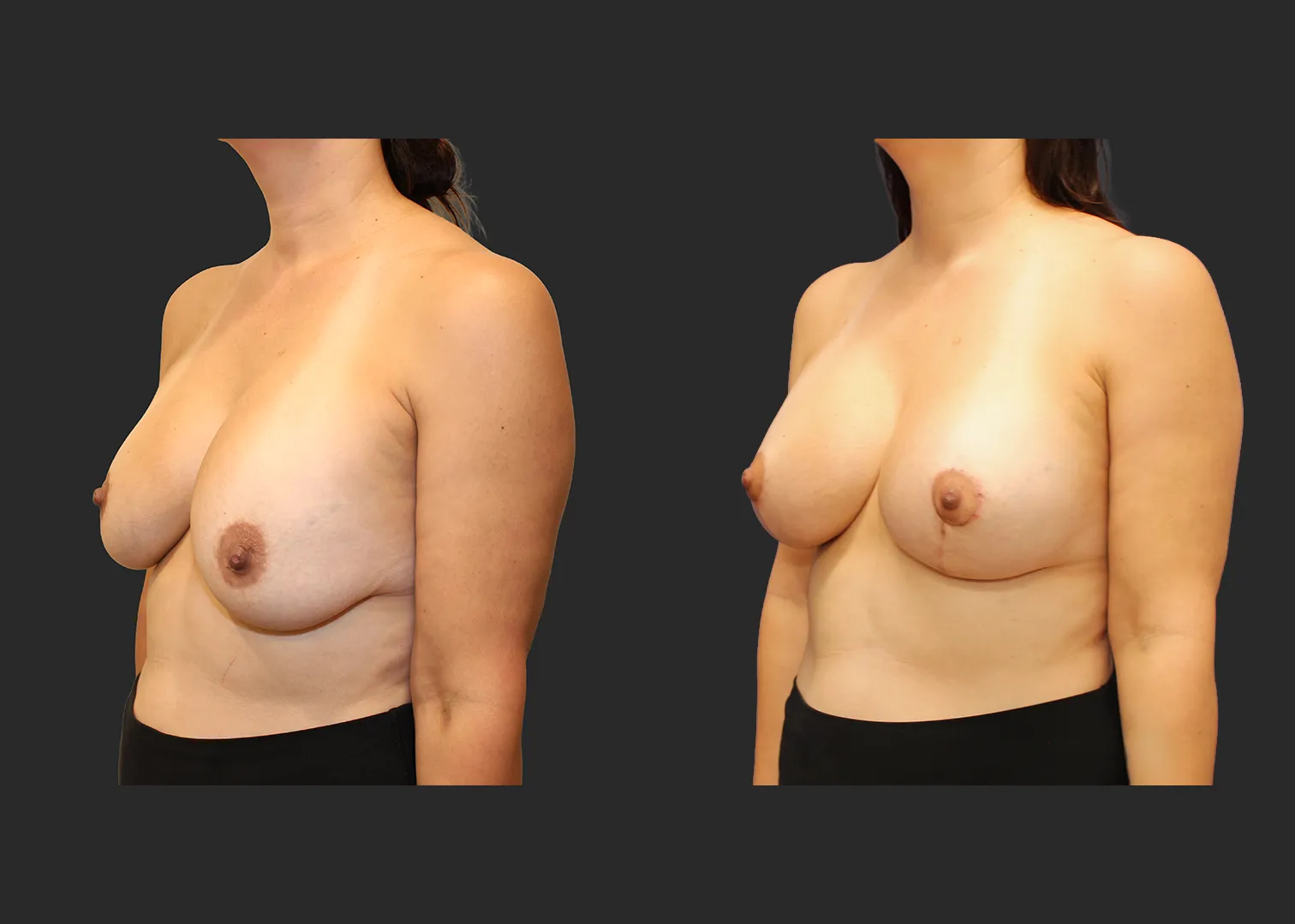 322890_Breast Implant Revision_Silicone_Left Oblique