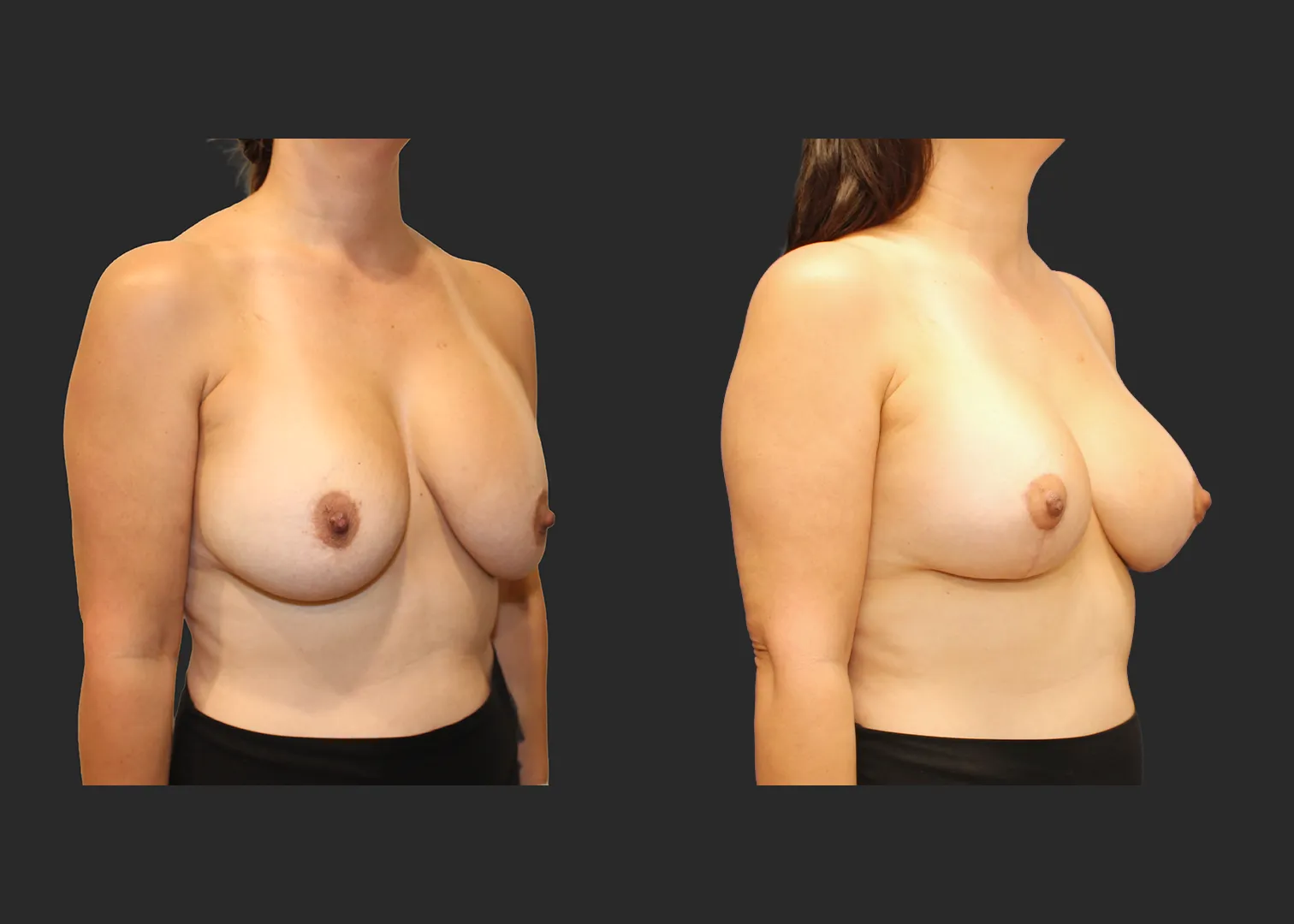 322890_Breast Implant Revision_Silicone_Right Oblique