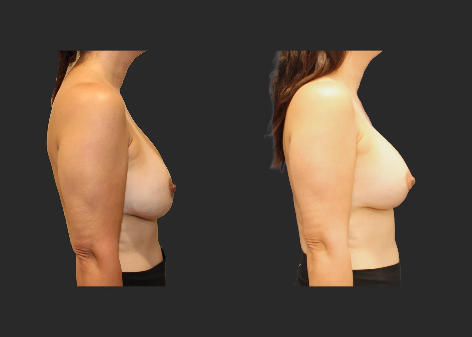 322890_Breast Implant Revision__Right