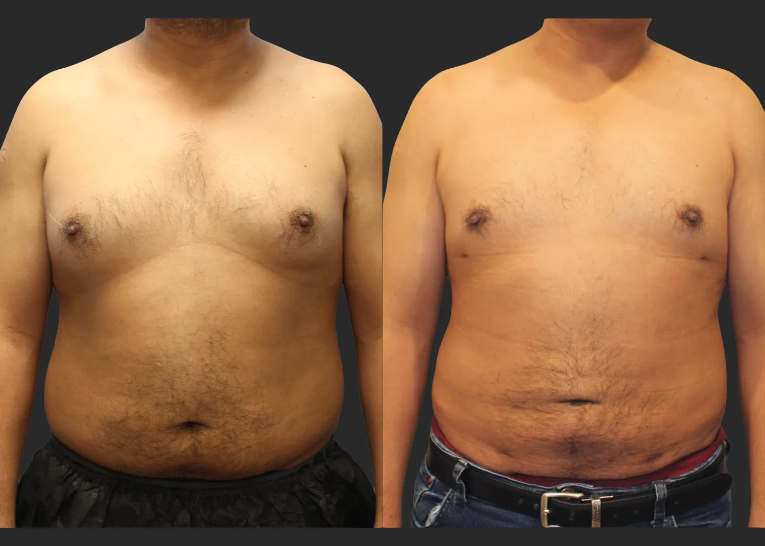 326104_S.A.F.E. Power-Assisted Liposuction_Abdomen_Renuvion Abdomen_Gynecomastia Correction with Liposuction_Before and After 3 months_Front
