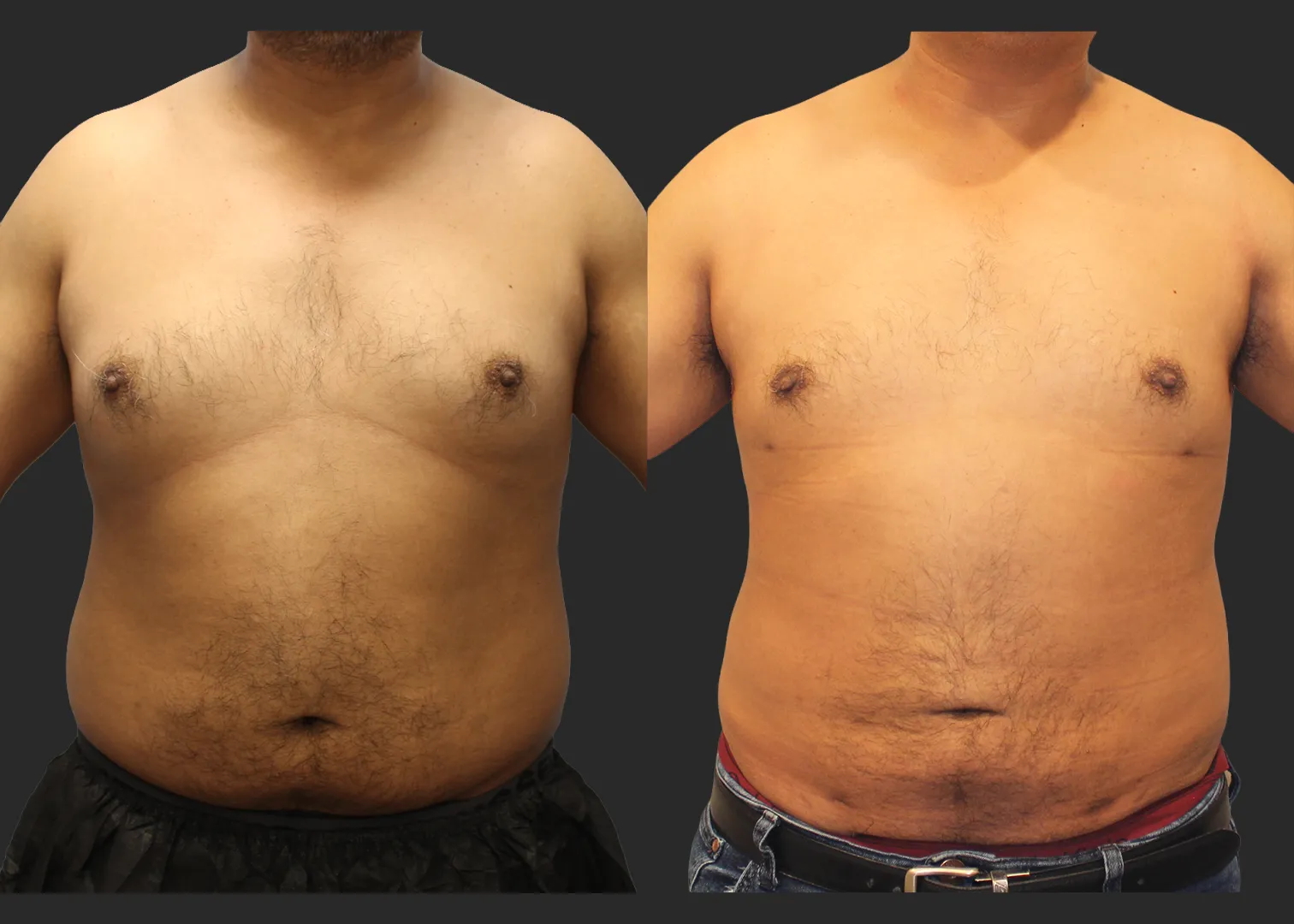 326104_S.A.F.E. Power-Assisted Liposuction_Abdomen_Renuvion Abdomen_Gynecomastia Correction with Liposuction_Before and After 3 months_Front_Arms Raised