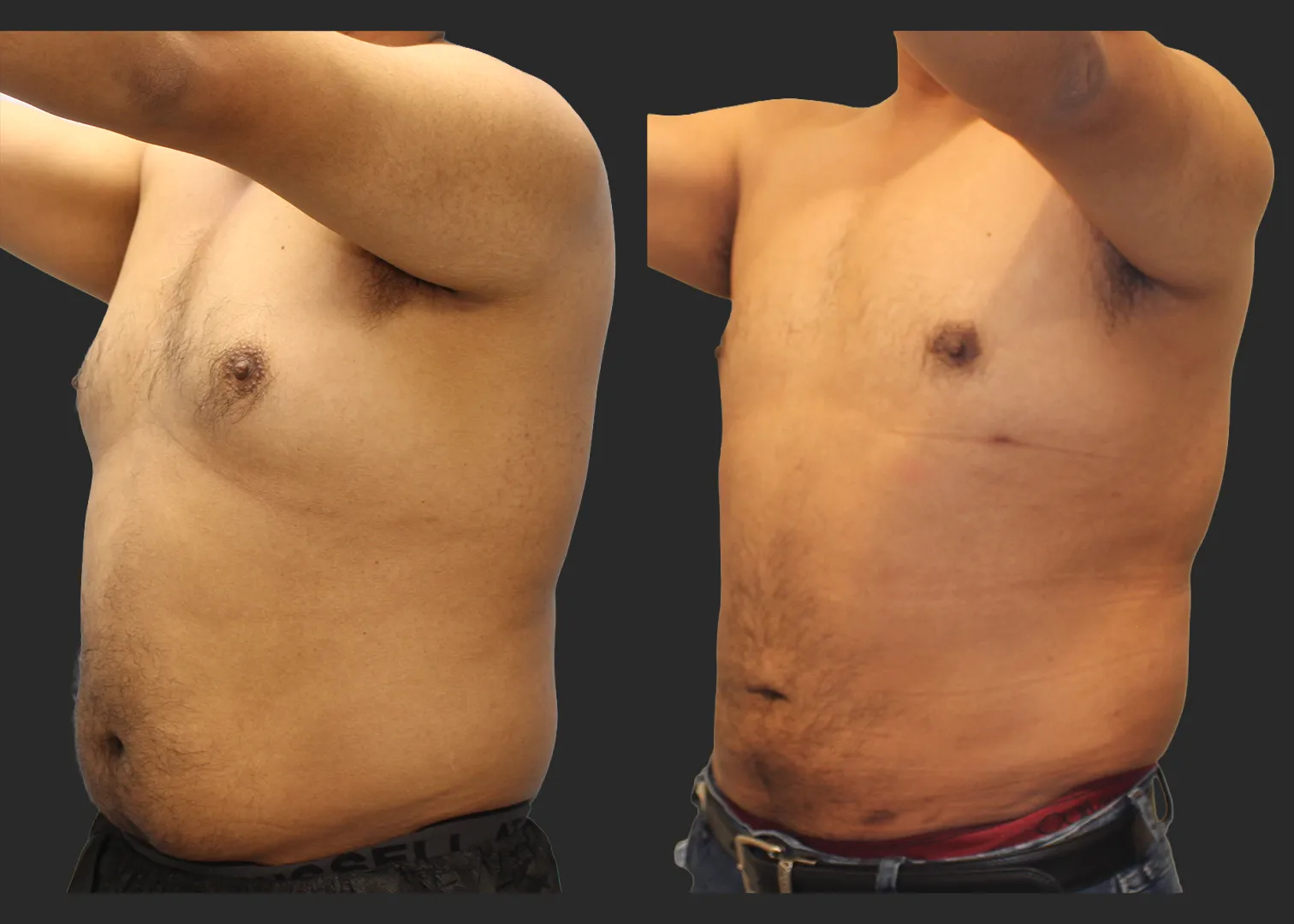 326104_S.A.F.E. Power-Assisted Liposuction_Abdomen_Renuvion Abdomen_Gynecomastia Correction with Liposuction_Before and After 3 months_Left Oblique