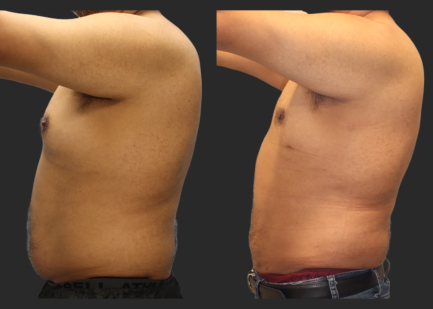326104_S.A.F.E. Power-Assisted Liposuction_Abdomen_Renuvion Abdomen_Gynecomastia Correction with Liposuction_Before and After 3 months_Left