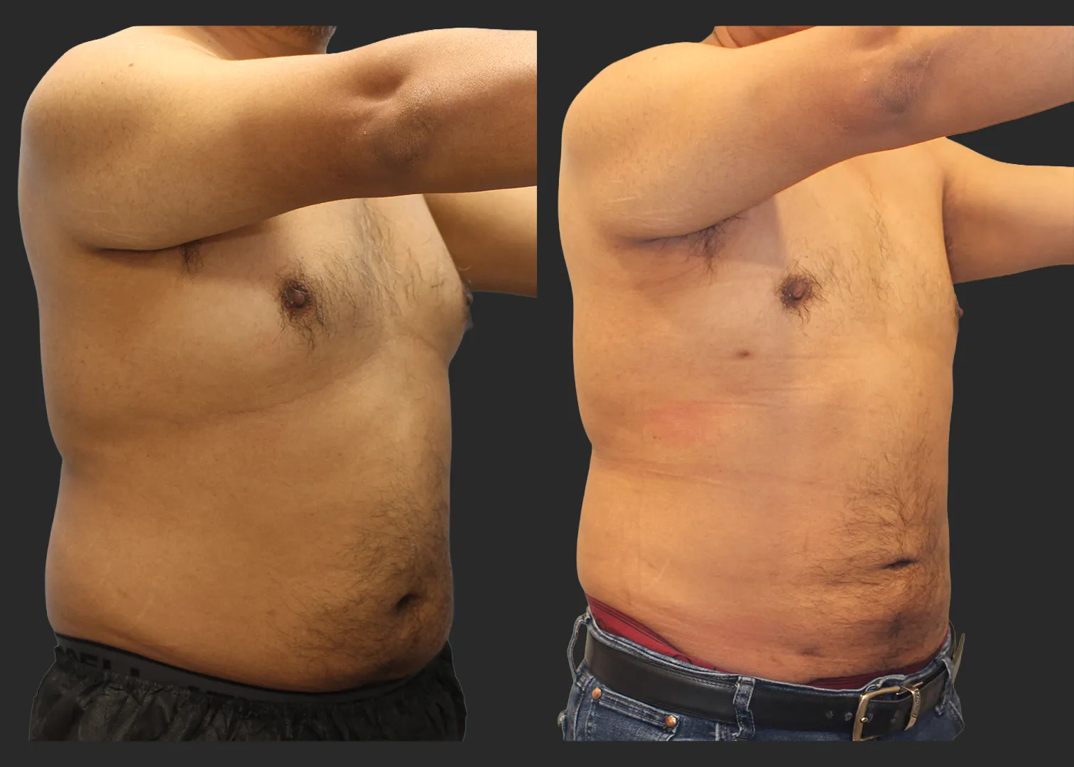 326104_S.A.F.E. Power-Assisted Liposuction_Abdomen_Renuvion Abdomen_Gynecomastia Correction with Liposuction_Before and After 3 months_Right Oblique